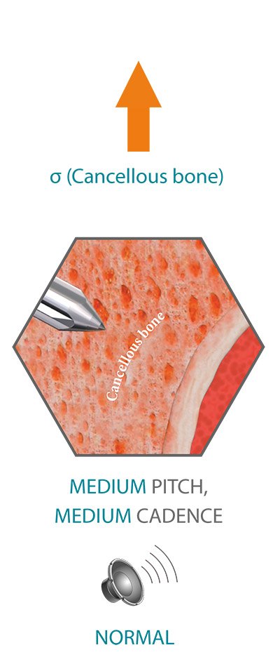SpineGuard-Normal-pitch
