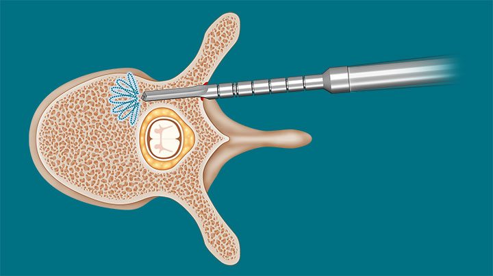 spineguard-surgical-technique-3