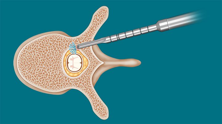 spineguard-surgical-technique-4