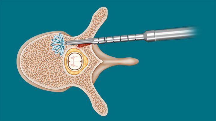 spineguard-surgical-technique-5