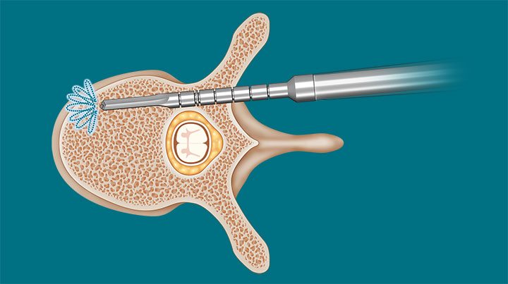 spineguard-surgical-technique-6